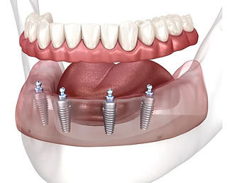 Dental Implants Near Me Nassau County, NY