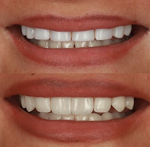 Before and after: Remedial work: replacing unnatural and failing composite veneers at Peninsula Dentists, Greenwich