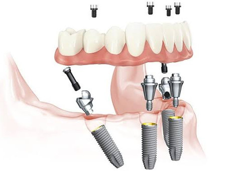การใส่ฟันทั้งปาก โดยใช้ฟันปลอม/สะพานฟัน ร่วมกับรากเทียม(ALL-ON-4,Teeth in A Day)