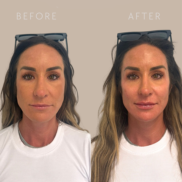 filler before and after