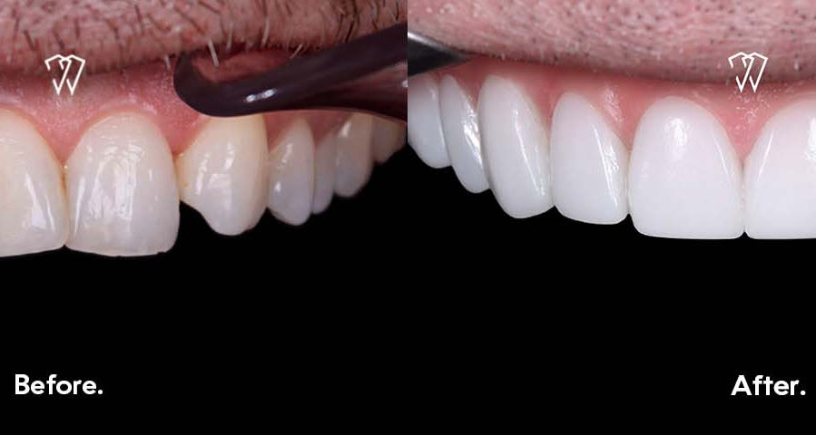 Composite bonding Essex before after