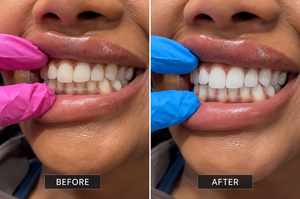 before-after-teeth-whitening.png