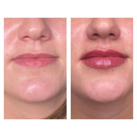 Results of 1ml hyaluronic acid lip fillers by Dr Hannah Jackman, based in KW Dental Dundee