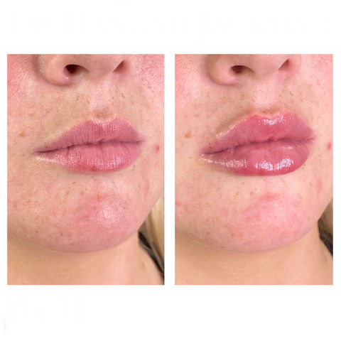 Results of 0.7ml hyaluronic acid lip fillers by Dr Hannah Jackman, based in KW Dental Dundee