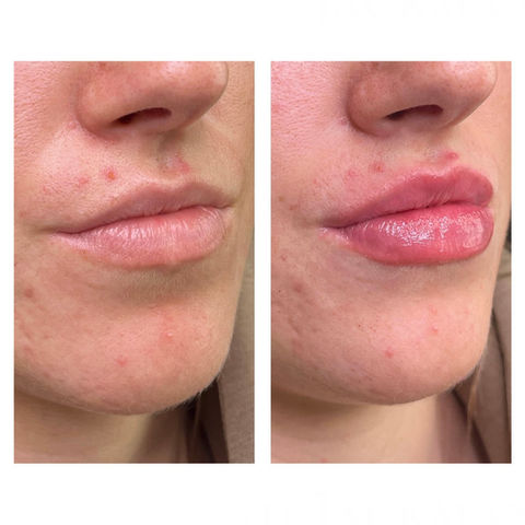 Results of 1ml hyaluronic acid lip fillers by Dr Hannah Jackman, based in KW Dental Dundee