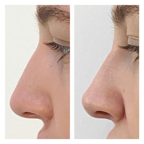 Non-surgical nose job to lift the nose tip using dermal fillers, carried out by Dr Hannah Jackman at KW Dental in Dundee.