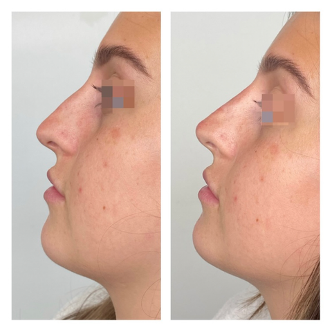 Results of a non-surgical rhinoplasty facial aesthetics procedure carried out with dermal fillers by Dr Hannah Jackman, based in KW Dental Dundee Scotland