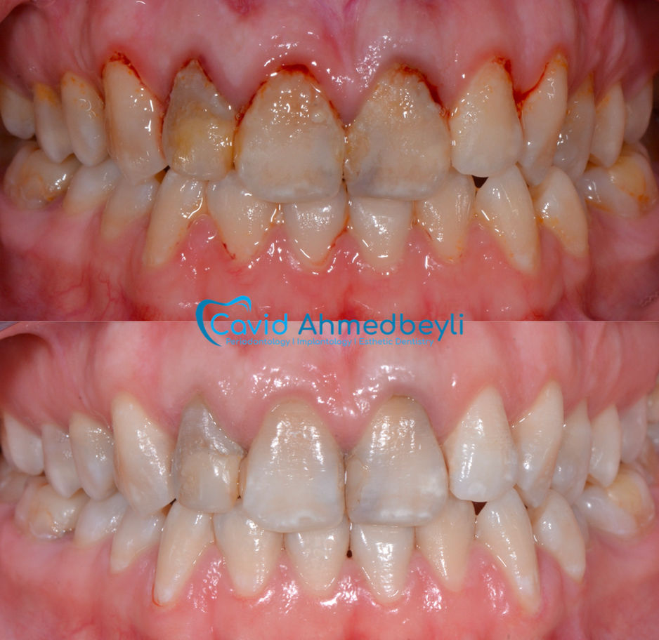 Diş əti müalicəsi