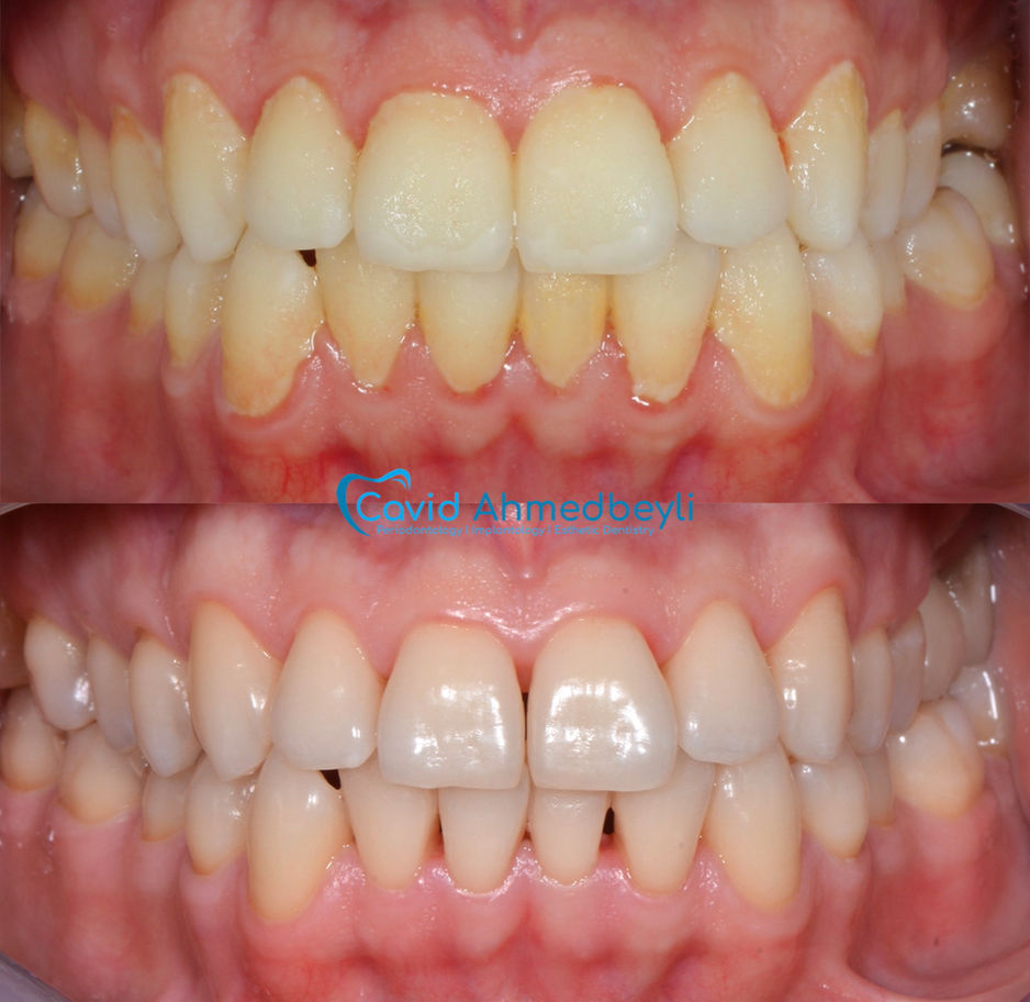 Diş əti müalicəsi