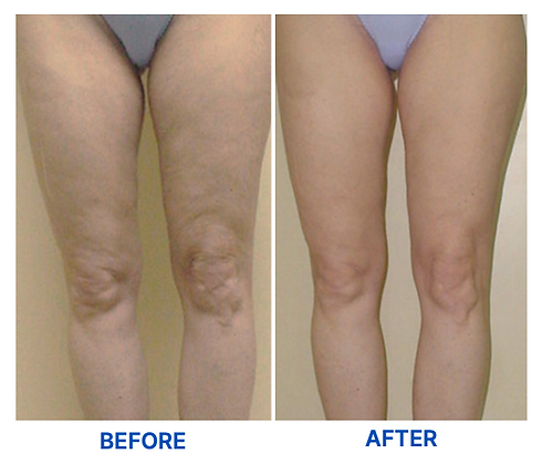 Results of Liquid Lipo in Greenville, SC