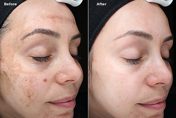 Results from a chemical peel in Greenville, SC