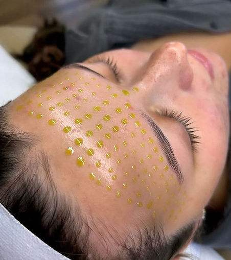 Chemical peel in Greenville, SC
