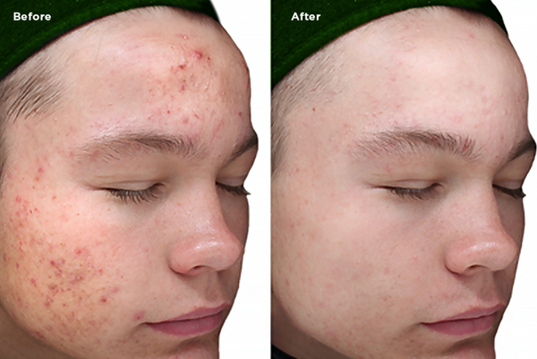 Before and after photos from a chemical peel in Greenville, SC