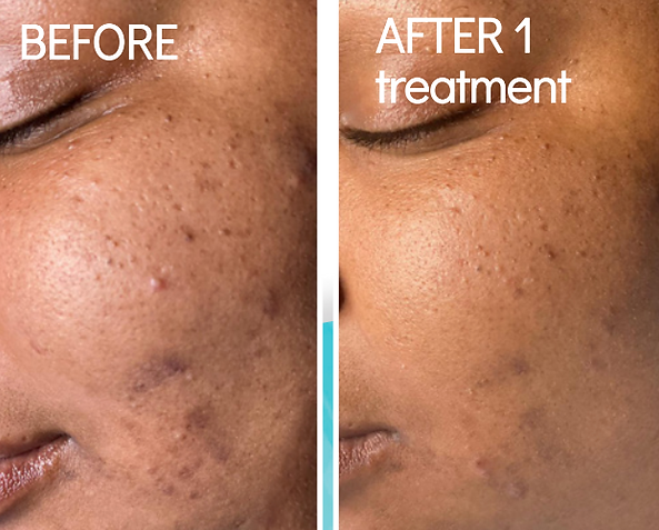 Before and after photos from a chemical peel in Greenville, SC
