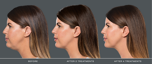Results of Kybella in Greenville