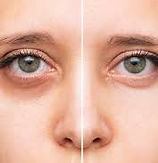Brightens dark circles PRP Under-Eye Treatment