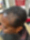 Hair Loss