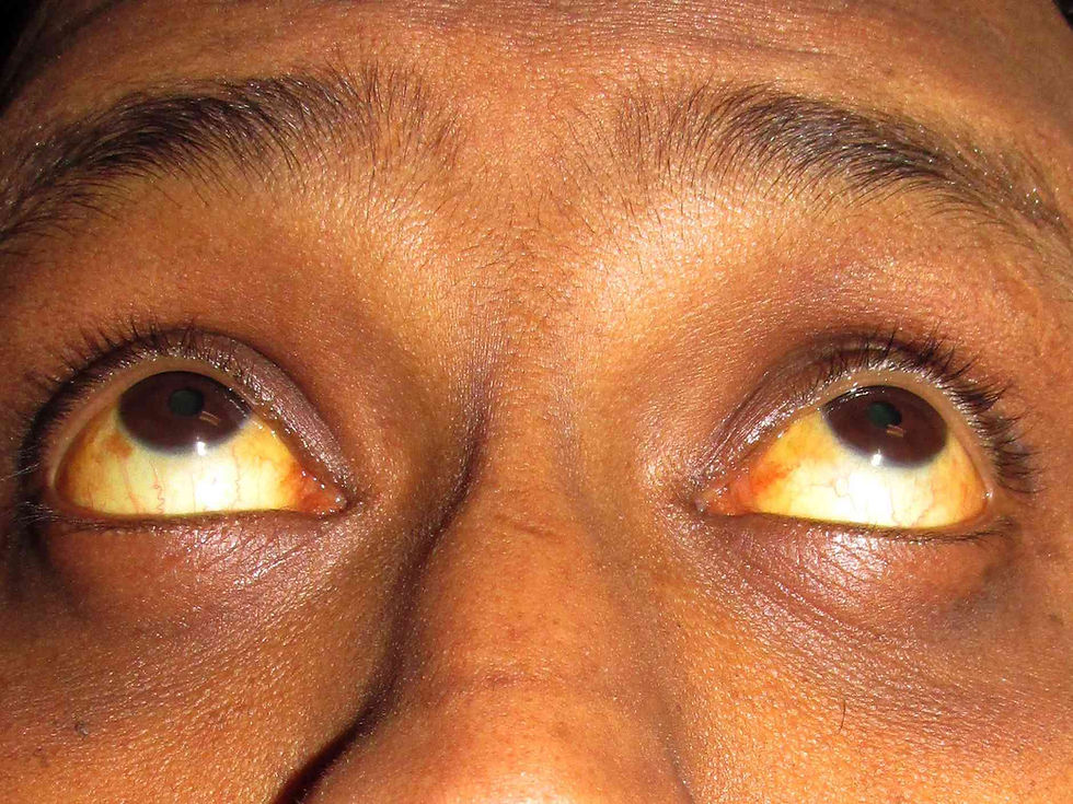 Hakeemi in Balochistan’s Jaundice Outbreak