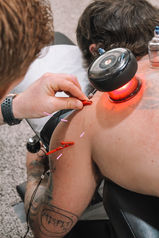 Chiropractor Using a Dry Needling and Cupping Technique on The Upper Part of Male Patients Back
