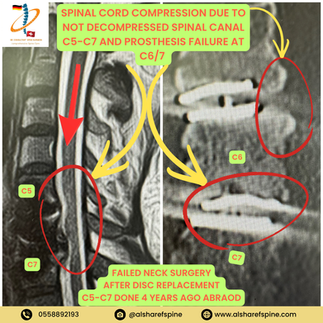 Revision Spine Surgery