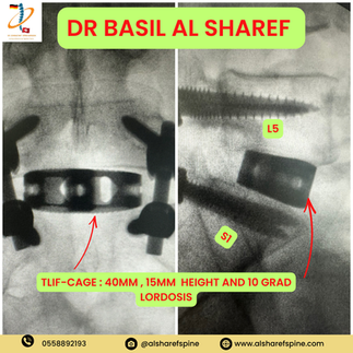 Spinal Fusion Surgery