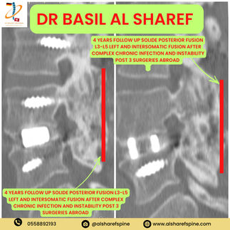 Revision Spine Surgery Dubai