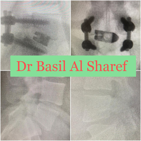 Alt="Spondylolisthesis Surgery Dubai"
