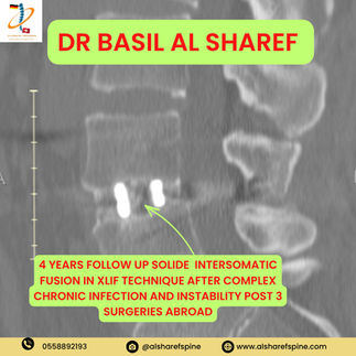 XLIF Surgery Dubai