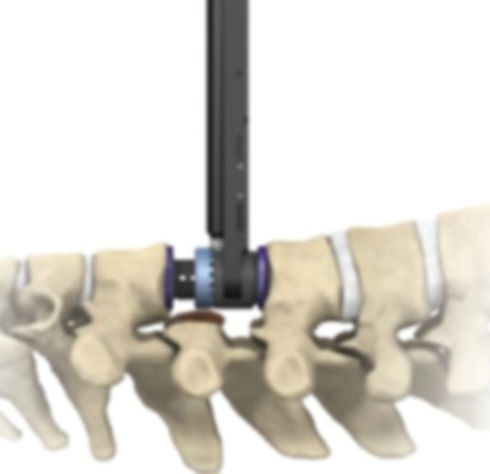 Alt=''Corpectomy Surgery''