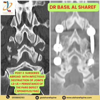 Complex Revision Spine Surgery