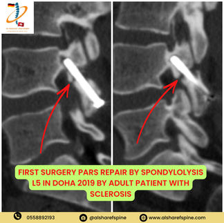 Spondylolisthesis Surgery Dubai