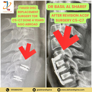 ACDF Surgery Dubai 