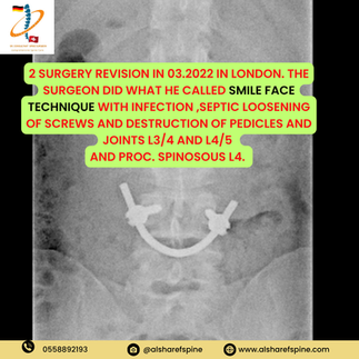 Spondylolisthesis Surgery Dubai