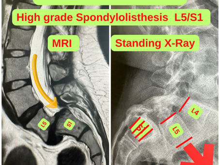 High-Grade Spondylolisthesis (Slipping Vertebra)