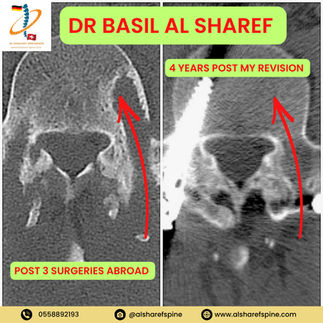 Revision Spine Surgery Dubai
