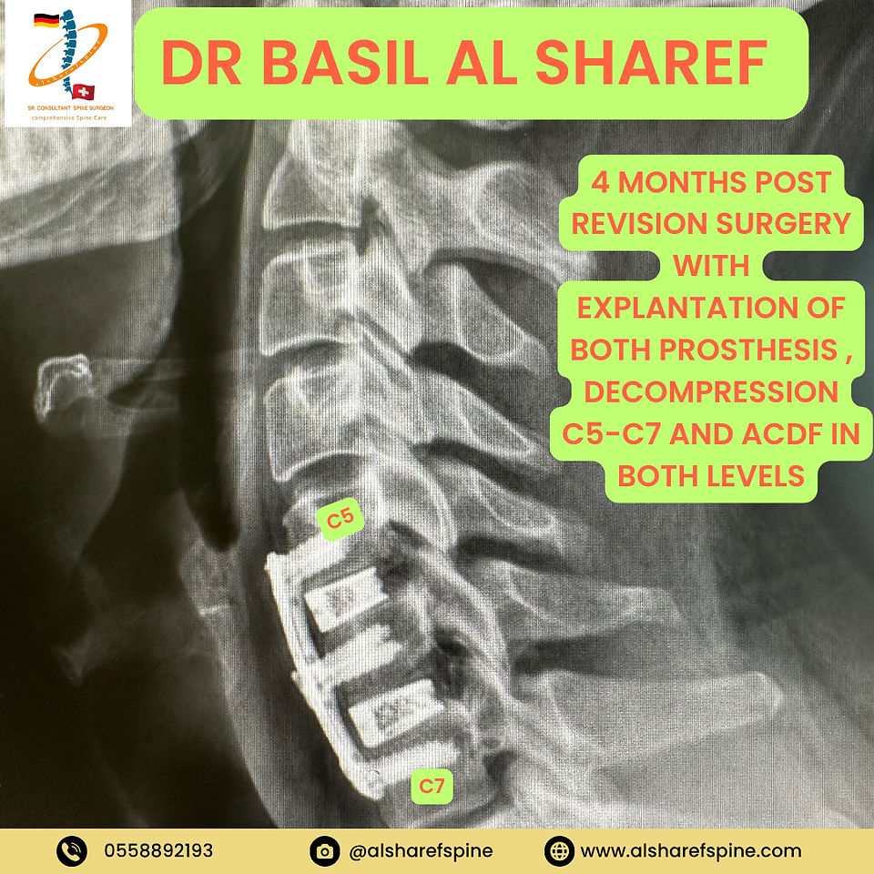 ACDF Surgery Dubai