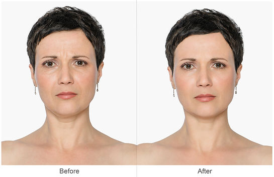 Woman with and without aging singes, double chin, worry wrinkles, nasolabial folds. Before