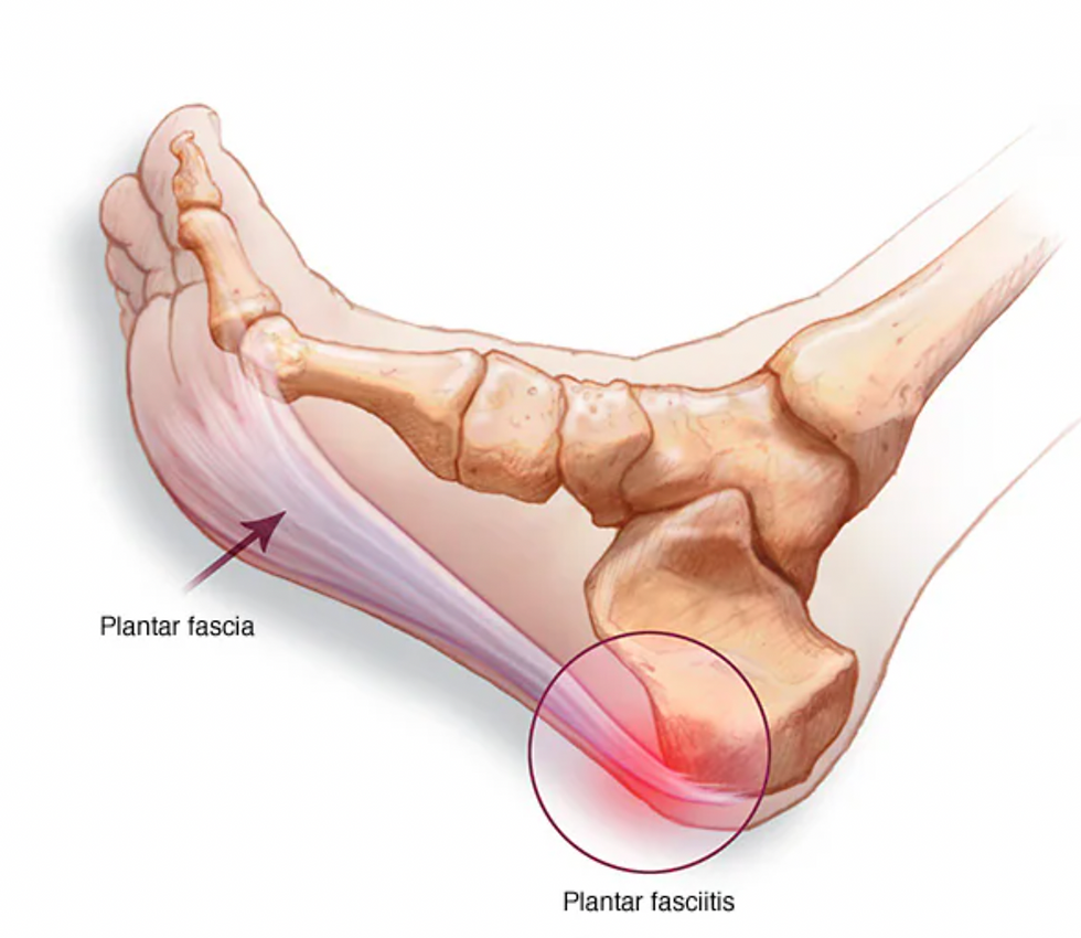 An animated illustration of a foot, with focus highlighted on the plantar fascia band under the heel and toes