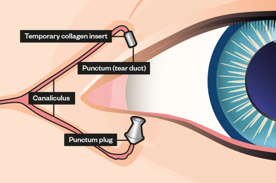 Anatomy Punctal Plugs