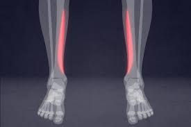 Shin splints – a pain in the leg and a pain to treat!