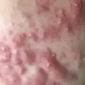 Cysts.webp