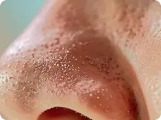 Skin with clogged pores before Hydrafacial treatment at KINS Clinic Singapore, emphasizing deep cleansing benefits.