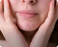 Acne Skin Booster Treatment in Singapore: How It Works and When to Consider It