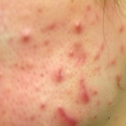Close-up photo of keloid scar symptoms treated by KINS Clinic Singapore, providing advanced scar removal solutions.