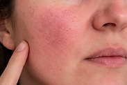Rosacea-associated flushing_edited.jpg