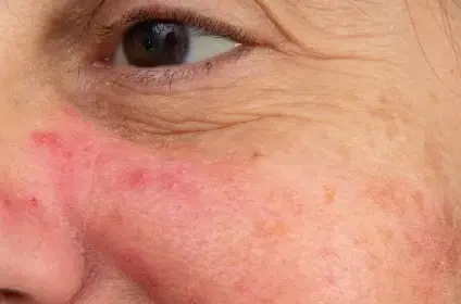 Eczema Pimples: Differences, Treatments, and When to See a Doctor