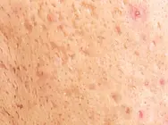 Image showing Acne Scars..webp