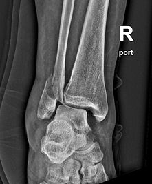Ankle Fracture Dislocation