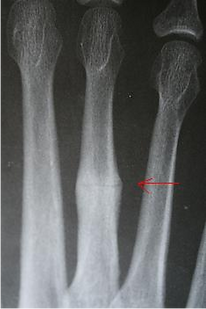 X-ray of a stress fracture.
