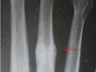 X-ray of a Stress Fracture